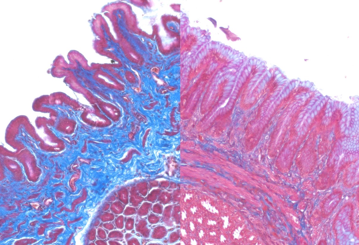 Healthy tissue and plasticosis-affected tissue in a flesh-footed shearwater.