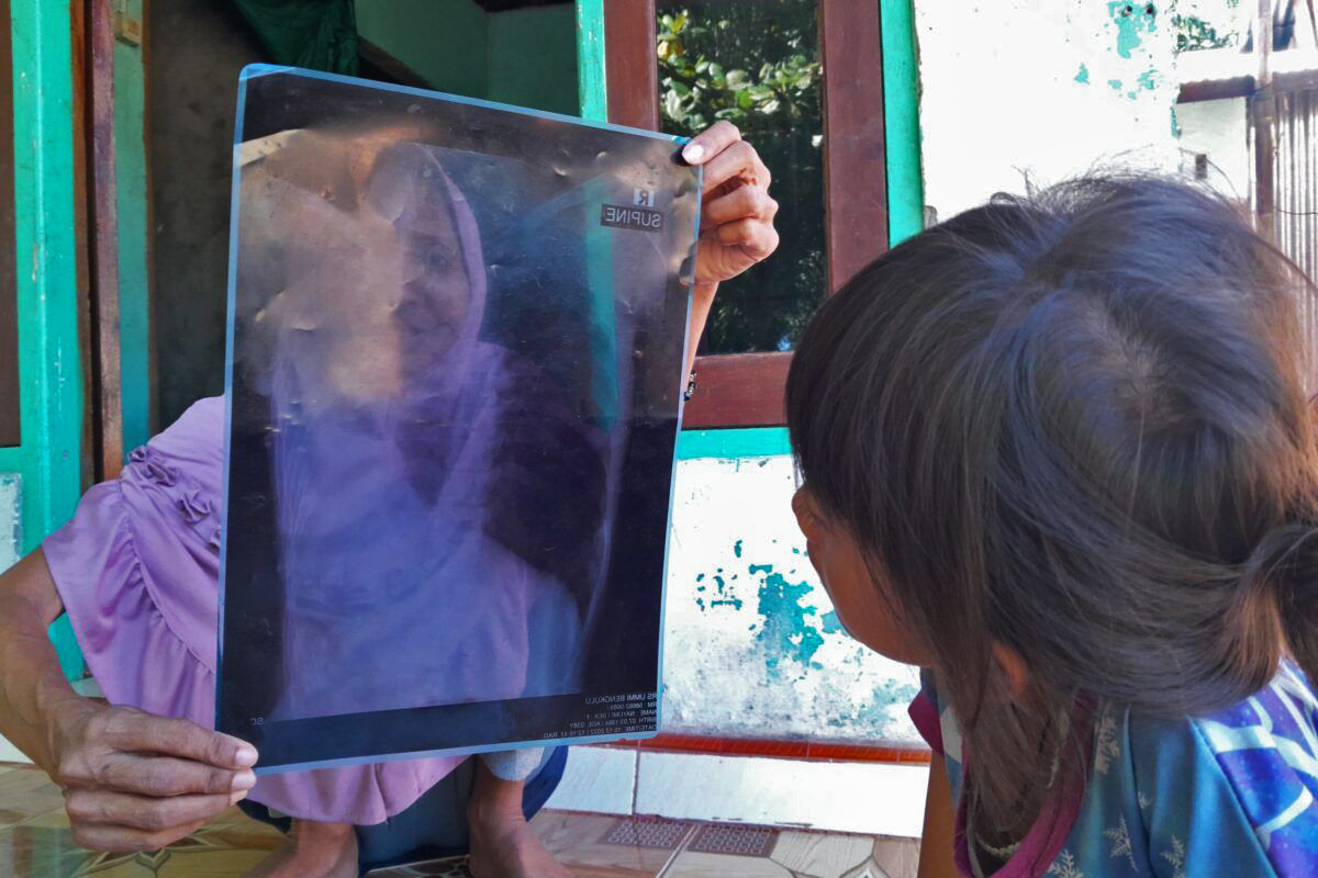 A person with chronic lung disease in Teluk Sepang holds up the X-ray image of their lungs.