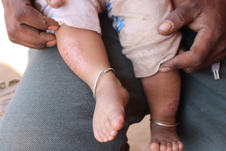 Melghat region is known for issues including malnutrition-related child mortality already. A doctor explains that the lack of access to clean water further leads to diarrhoea and malnutrition, and children developing skin infections. Image by Abhijeet Tangde.